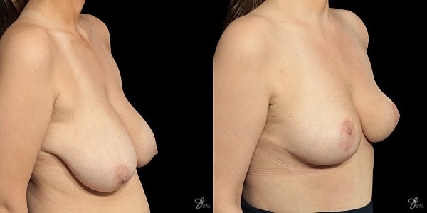 Breast Lift Before & After