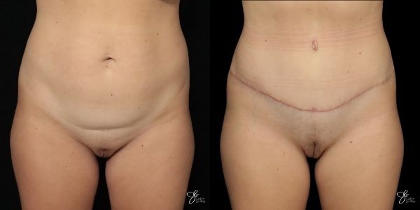 Tummy Tuck Before & After