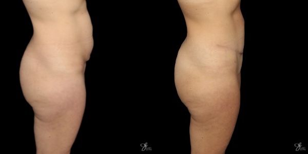 Tummy Tuck Before & After