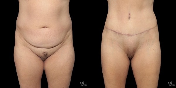 Tummy Tuck Before & After