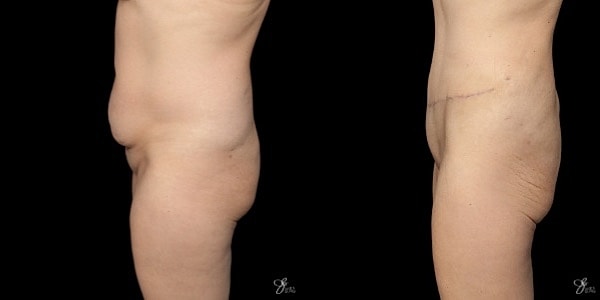 Tummy Tuck Before & After
