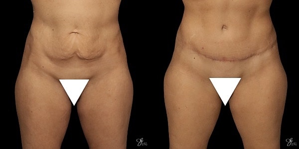 Tummy Tuck Before & After