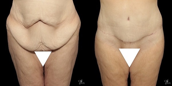 Tummy Tuck Before & After