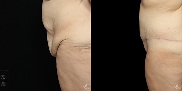 Tummy Tuck Before & After
