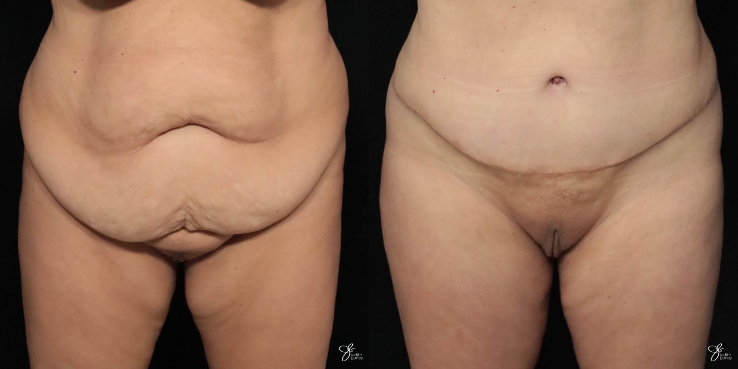 Tummy Tuck Before & After