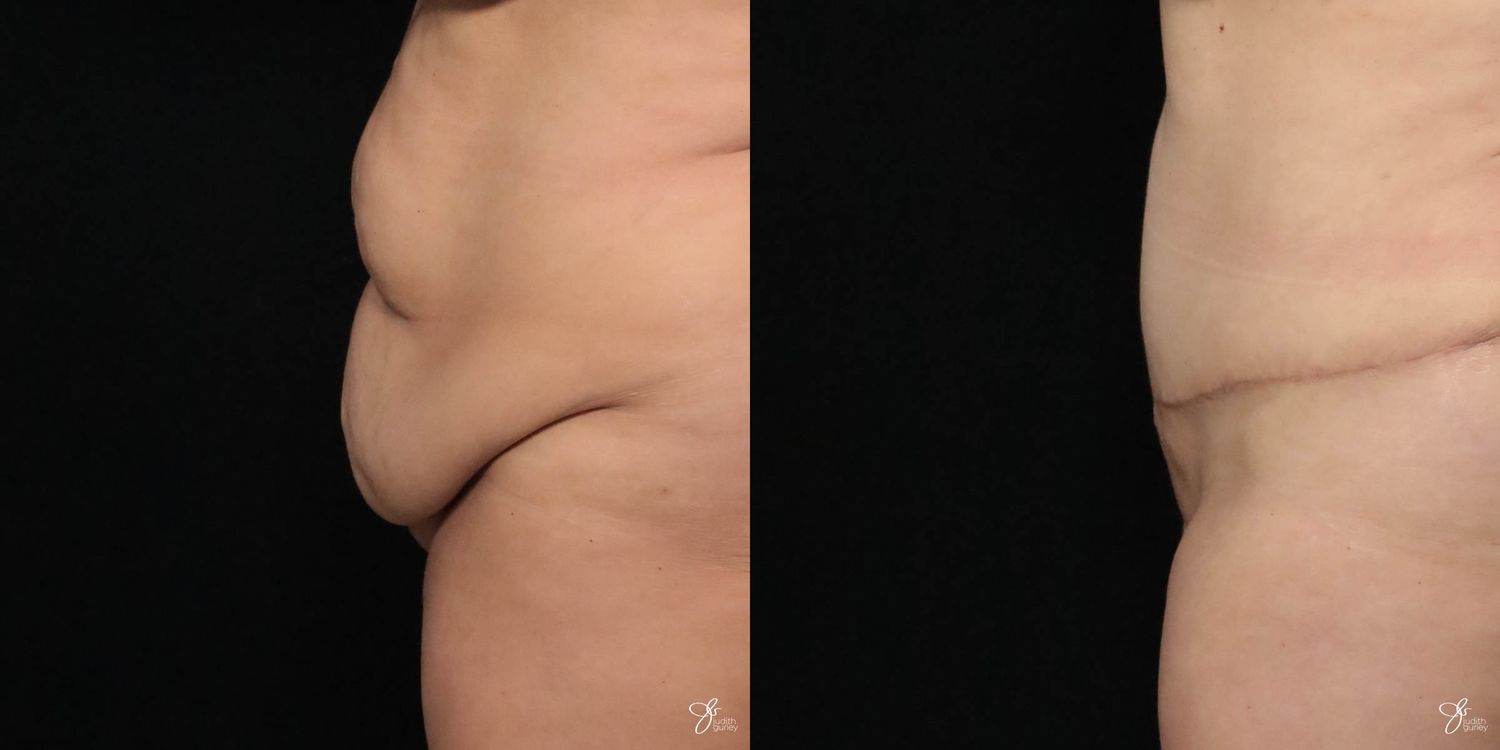 Tummy Tuck Before & After
