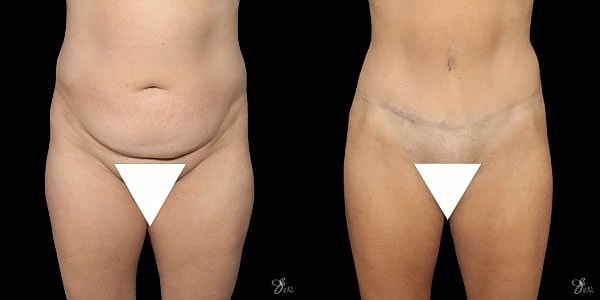 Tummy Tuck Before & After