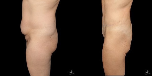 Tummy Tuck Before & After