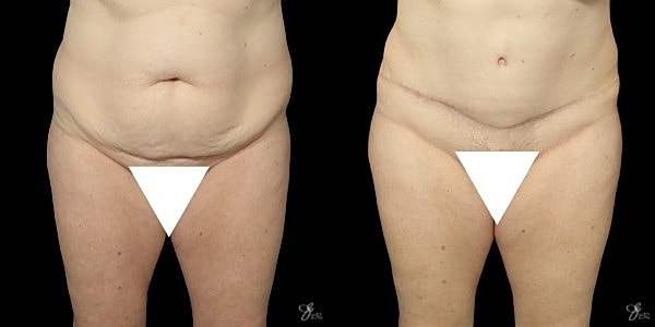 Tummy Tuck Before & After