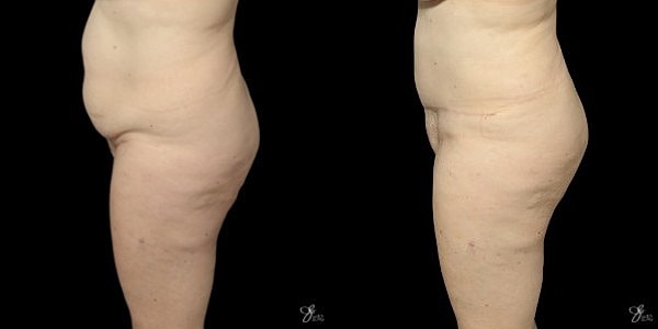 Tummy Tuck Before & After