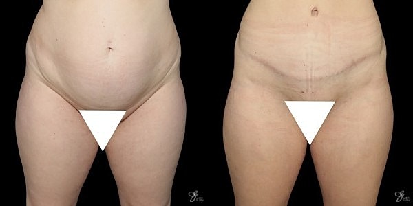Tummy Tuck Before & After