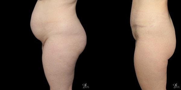 Tummy Tuck Before & After