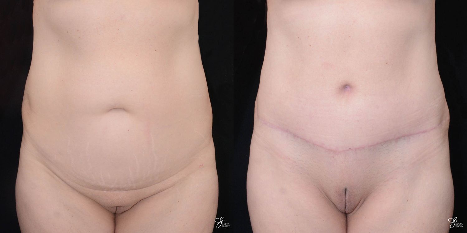 Tummy Tuck Before & After