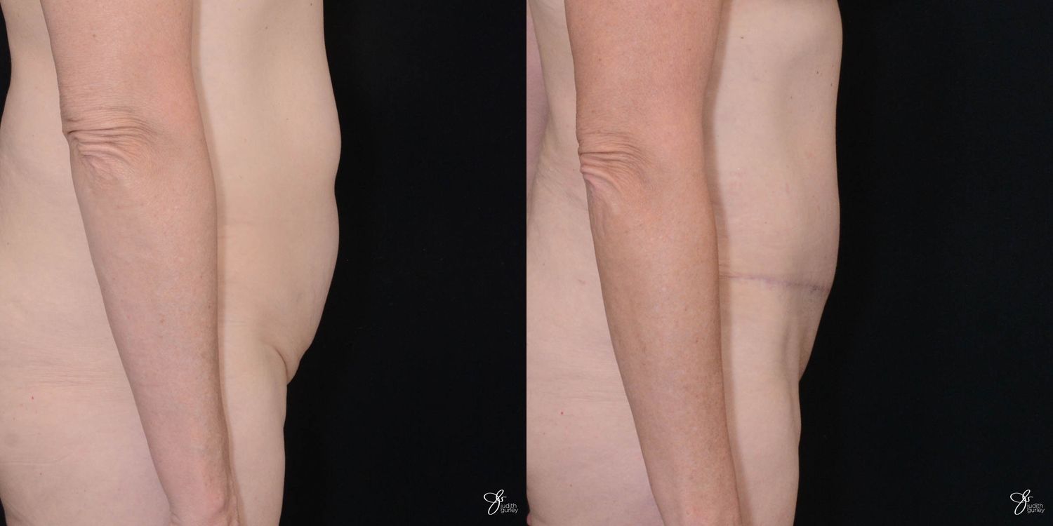 Tummy Tuck Before & After
