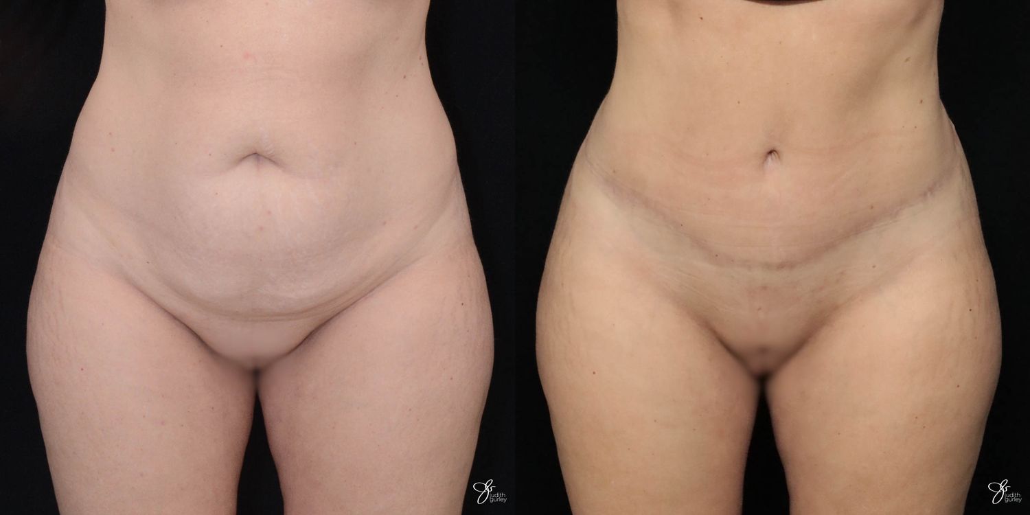 Tummy Tuck Before & After