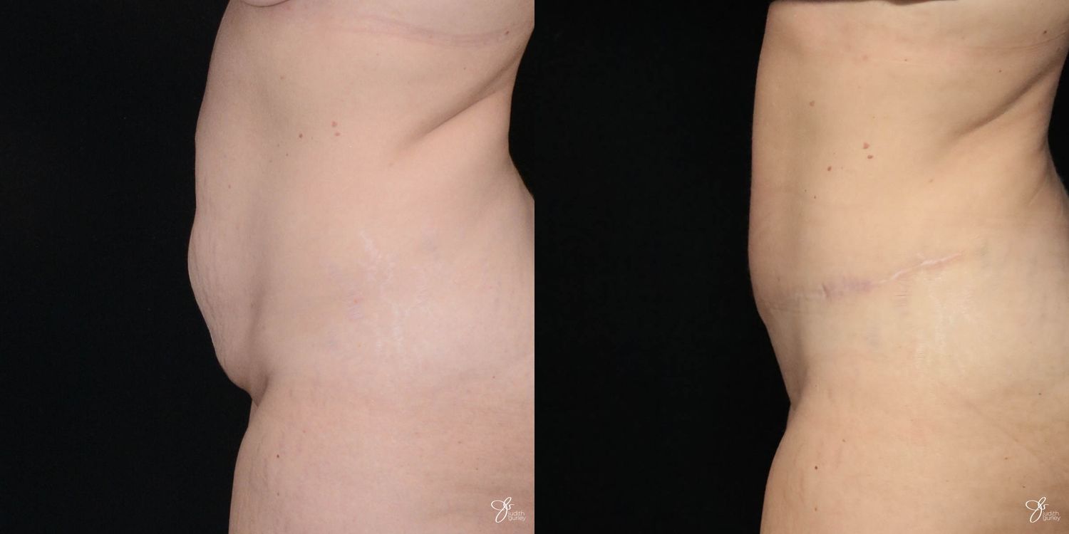 Tummy Tuck Before & After