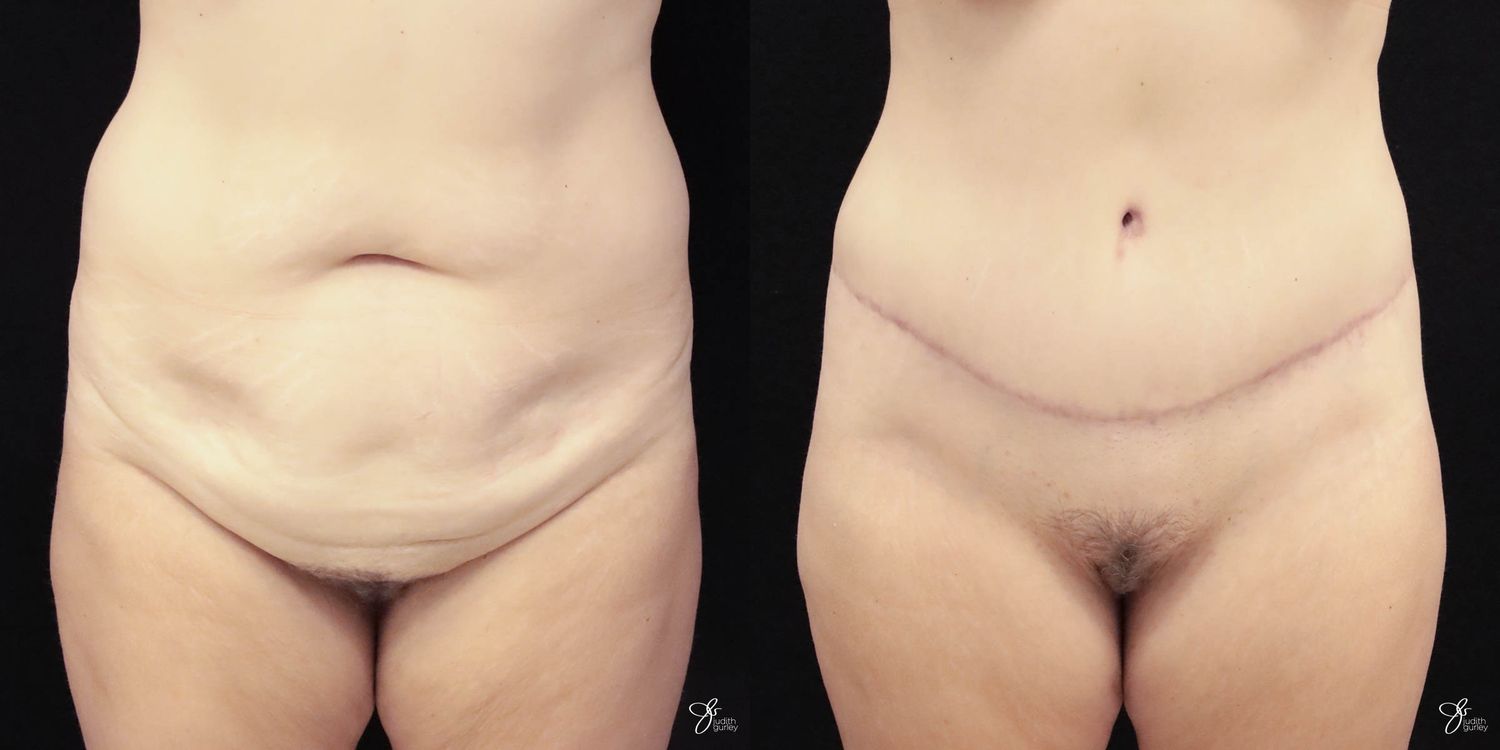 Tummy Tuck Before & After
