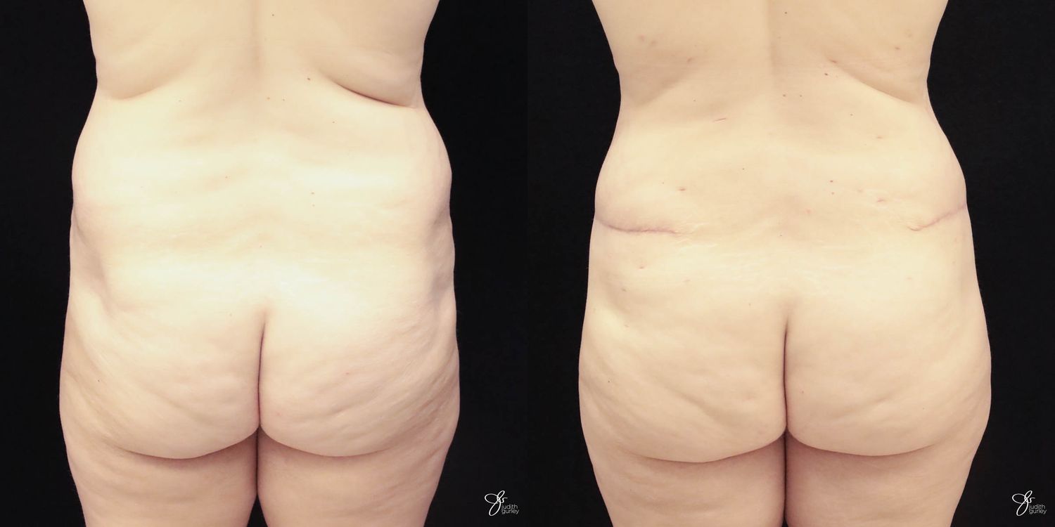 Tummy Tuck Before & After