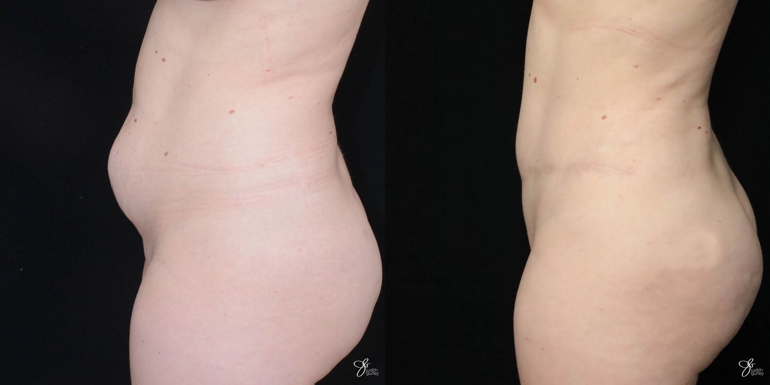 Tummy Tuck Before & After