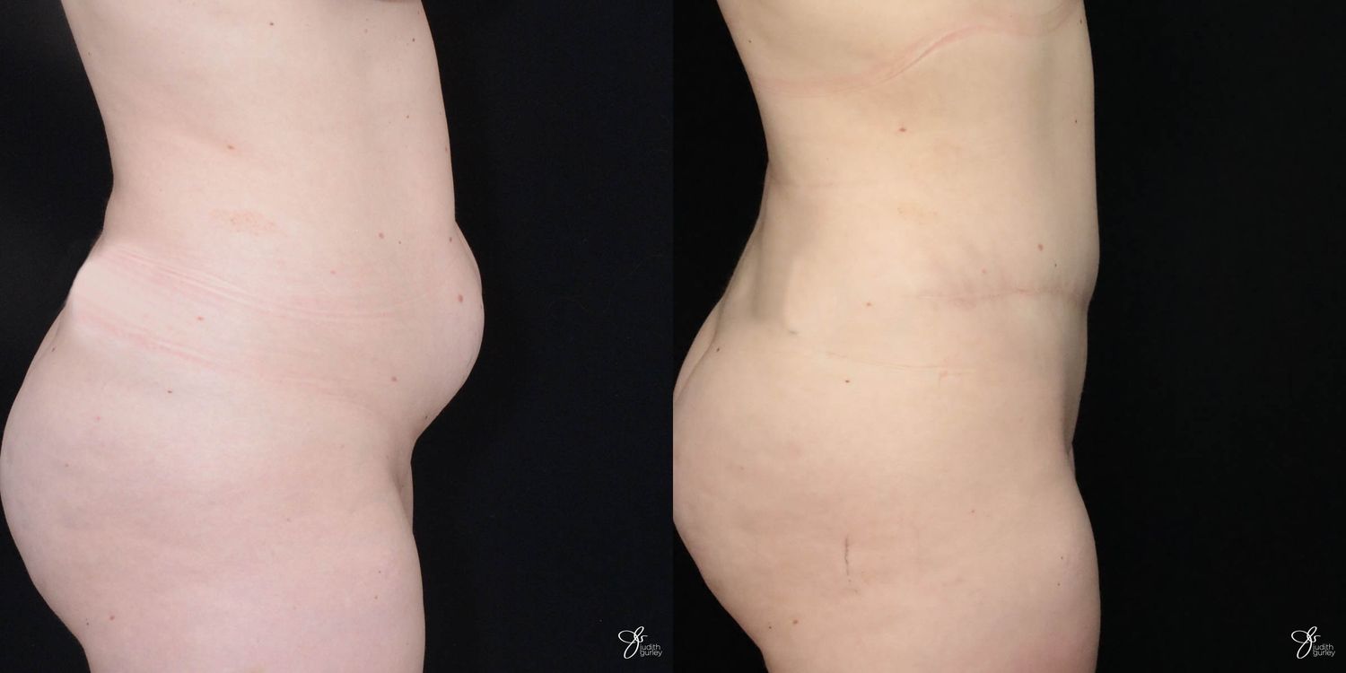 Tummy Tuck Before & After
