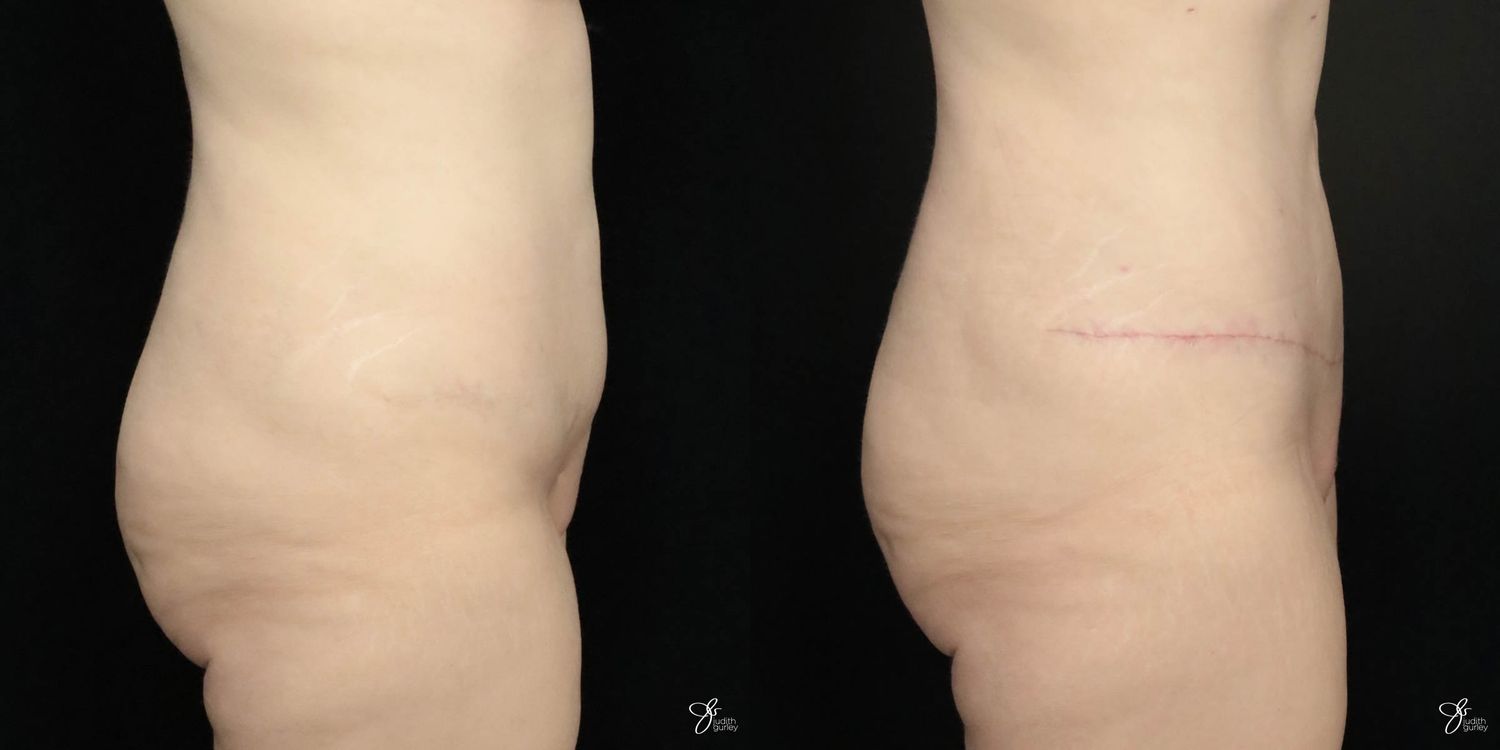 Tummy Tuck Before & After