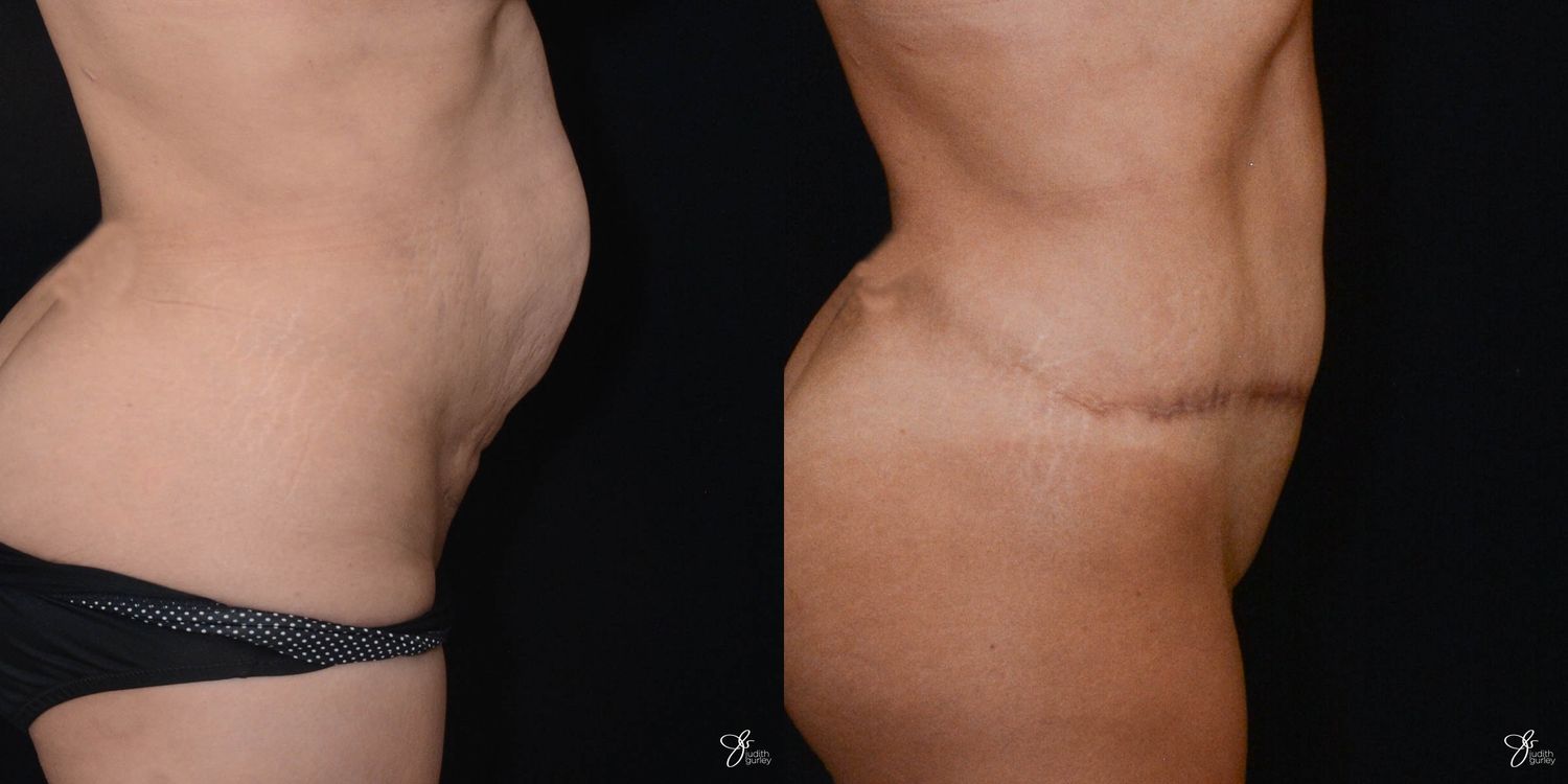 Tummy Tuck Before & After