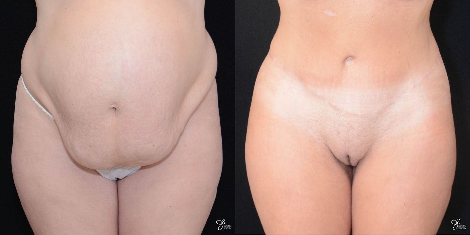 Tummy Tuck Before & After
