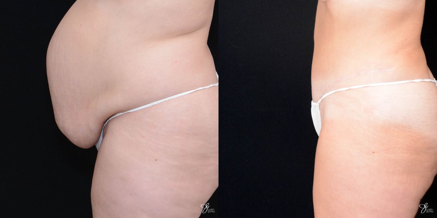 Tummy Tuck Before & After