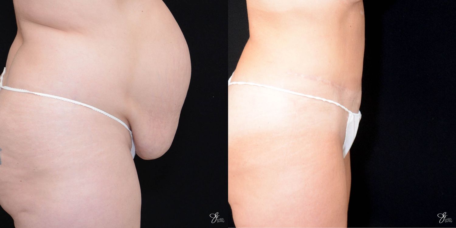 Tummy Tuck Before & After