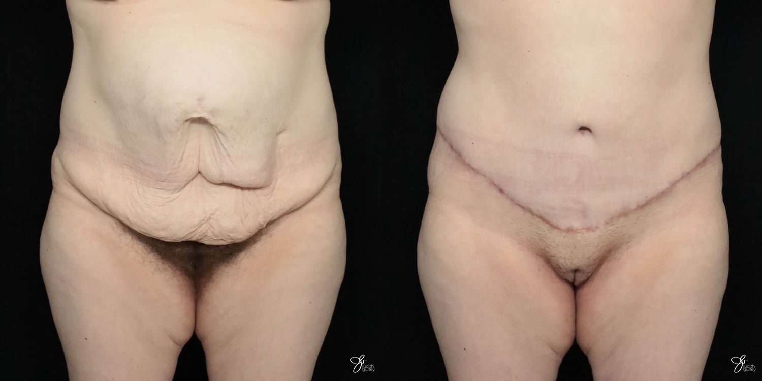 Tummy Tuck Before & After