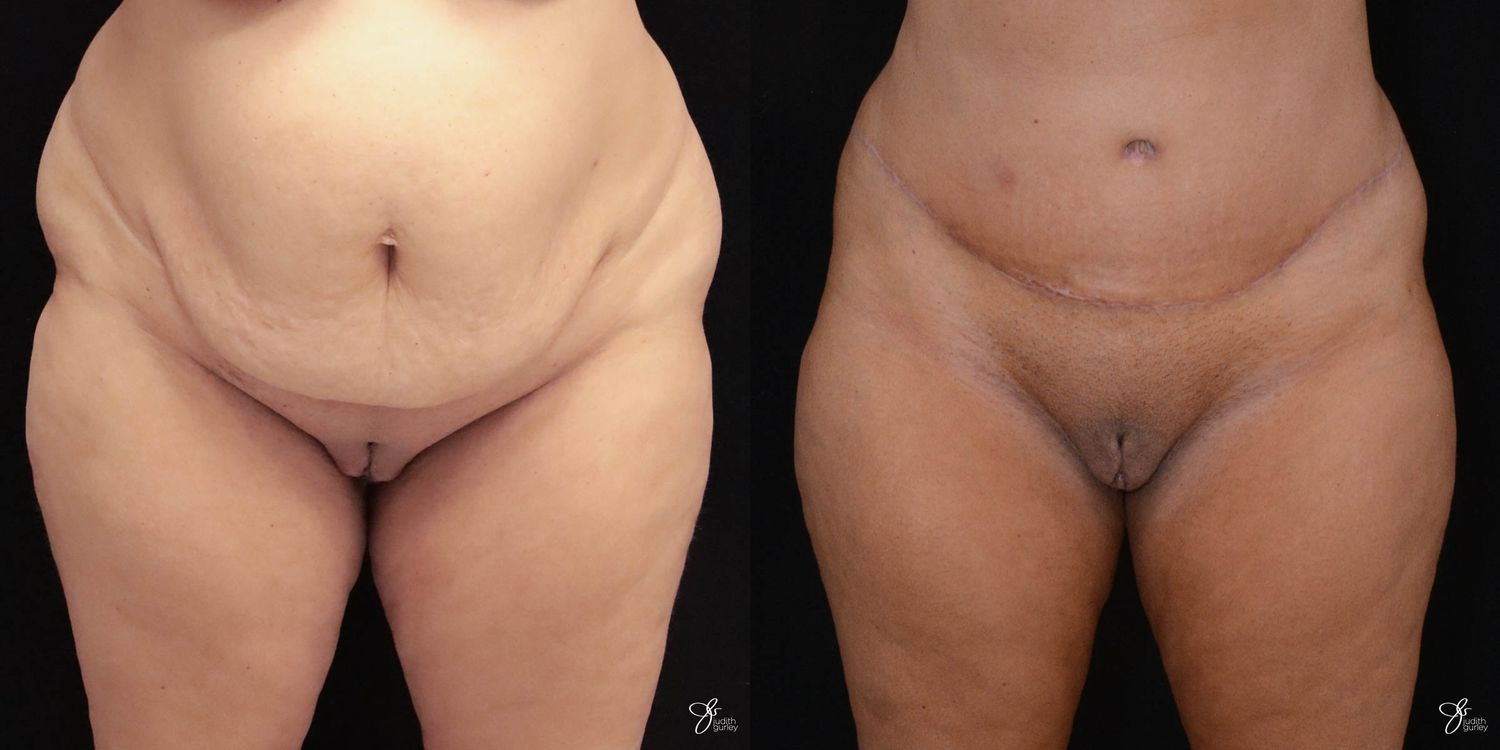 Tummy Tuck Before & After