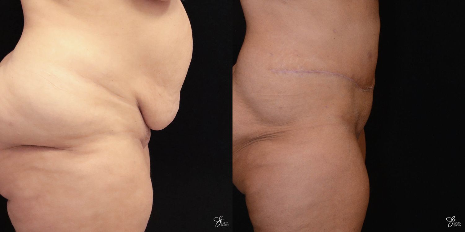 Tummy Tuck Before & After