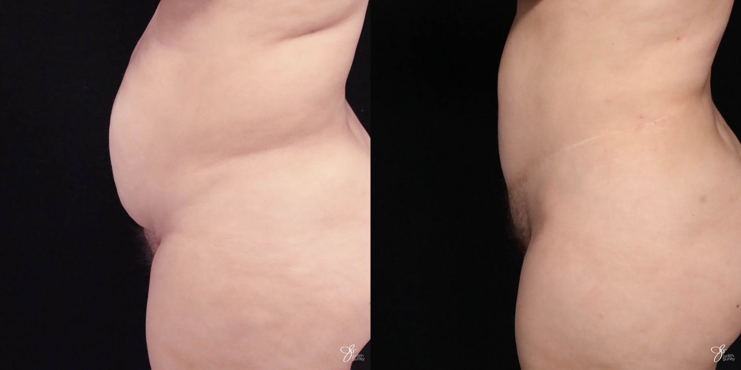 Tummy Tuck Before & After