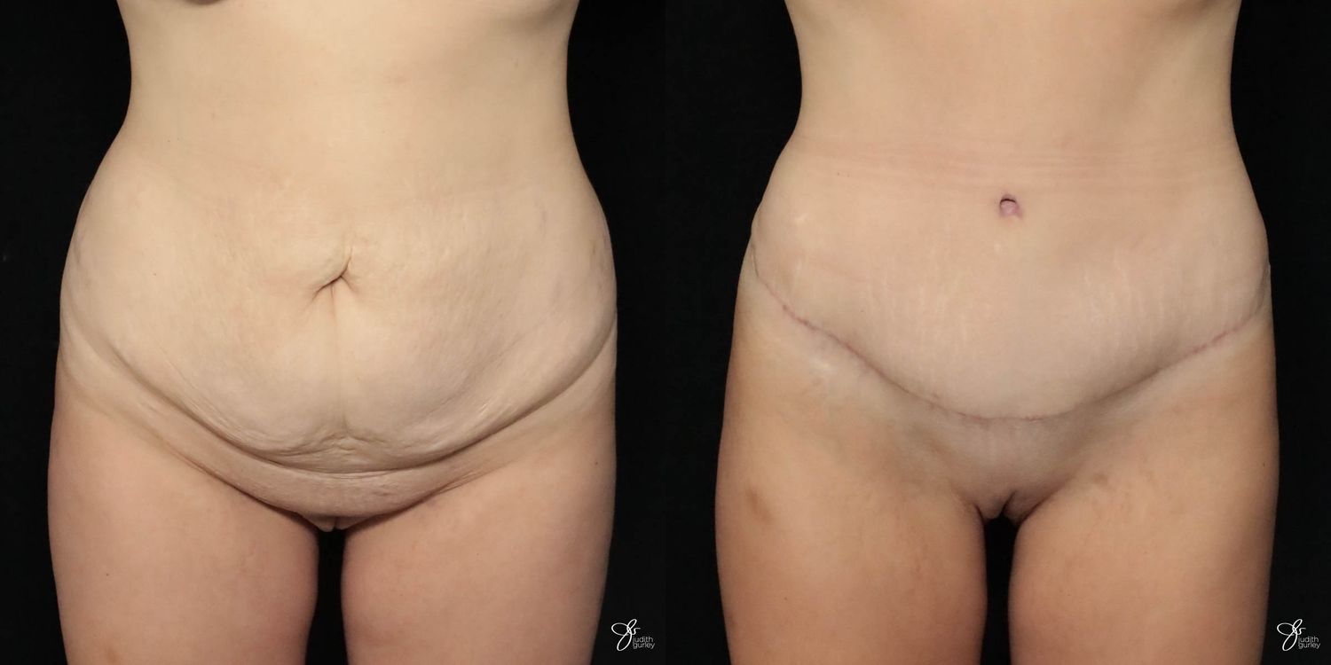 Tummy Tuck Before & After