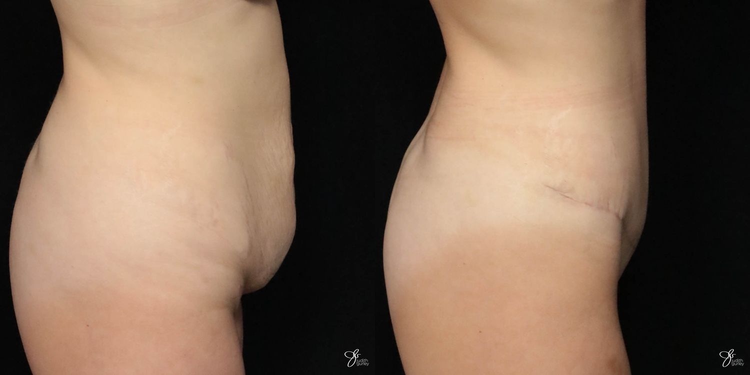 Tummy Tuck Before & After