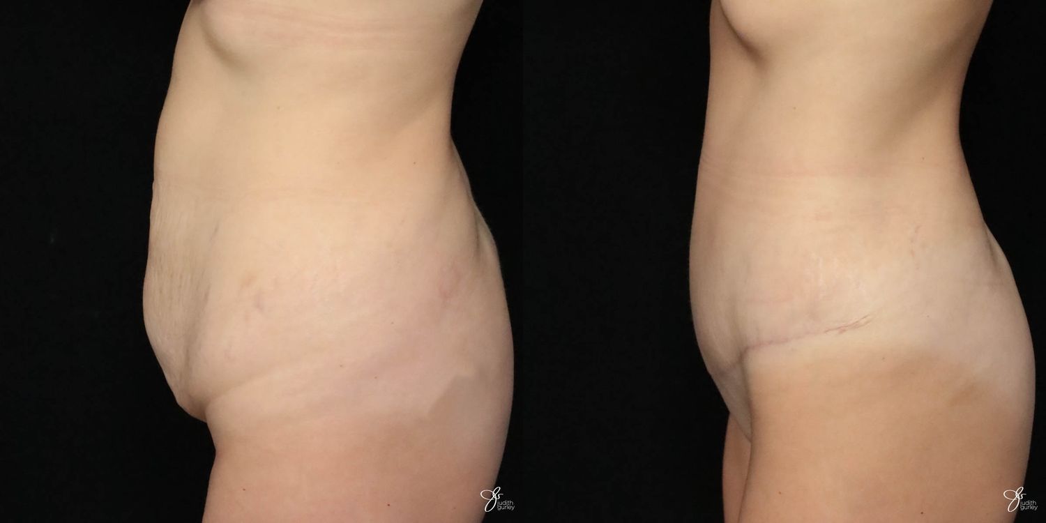 Tummy Tuck Before & After