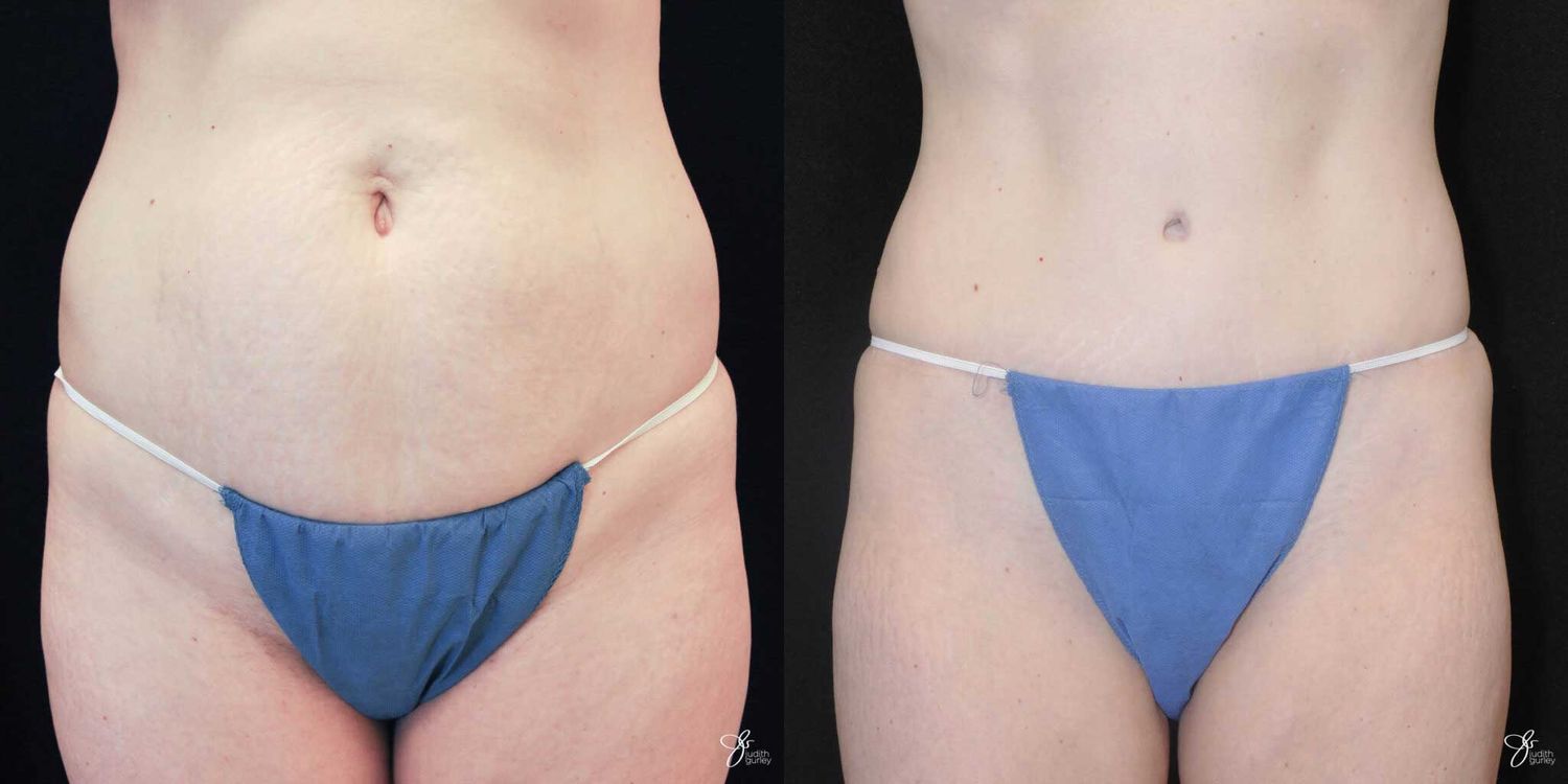 Tummy Tuck Before & After