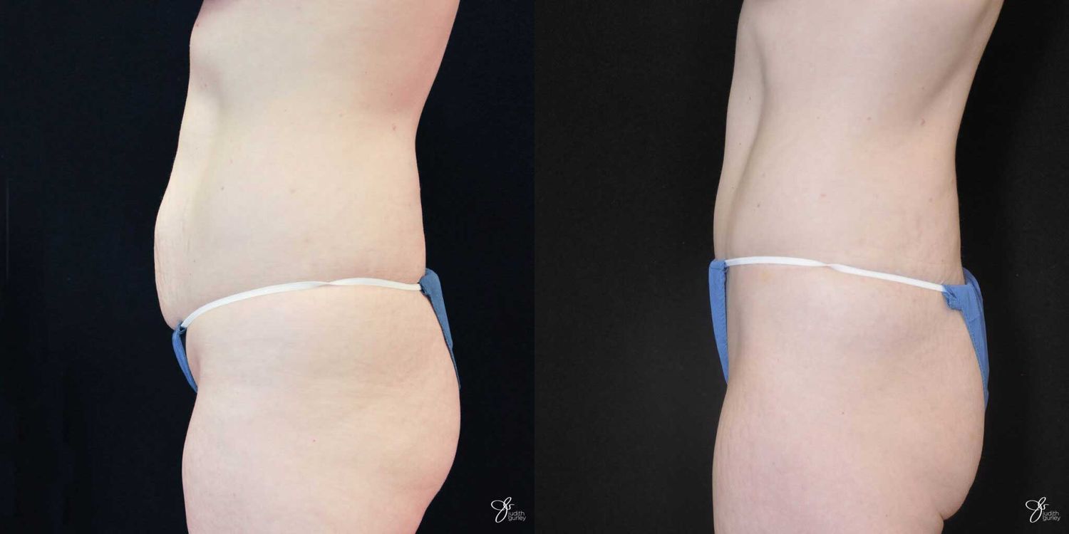 Tummy Tuck Before & After