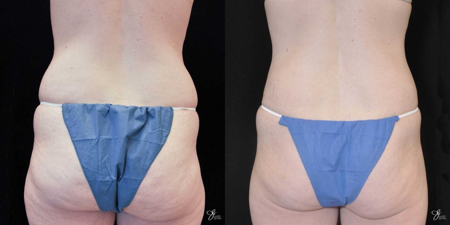 Tummy Tuck Before & After