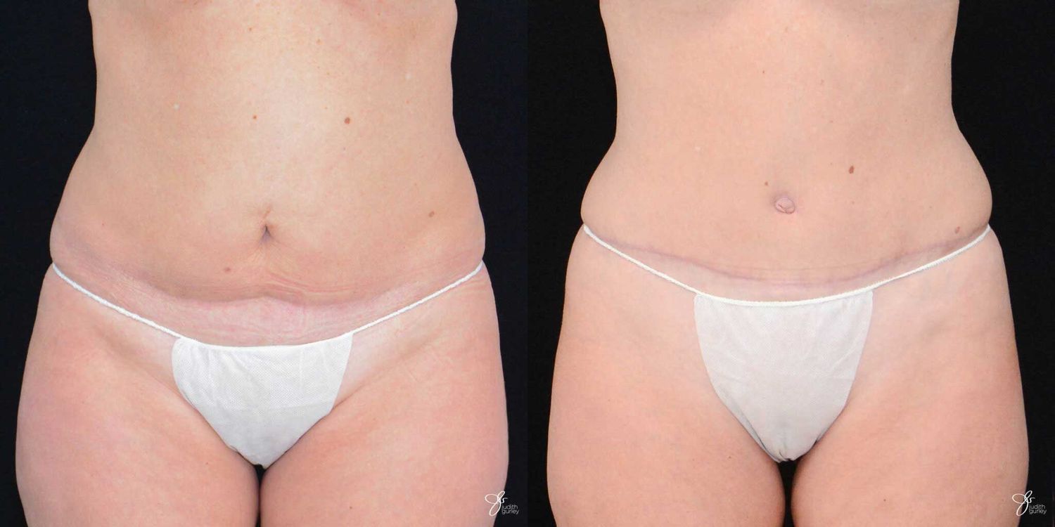 Tummy Tuck Before & After