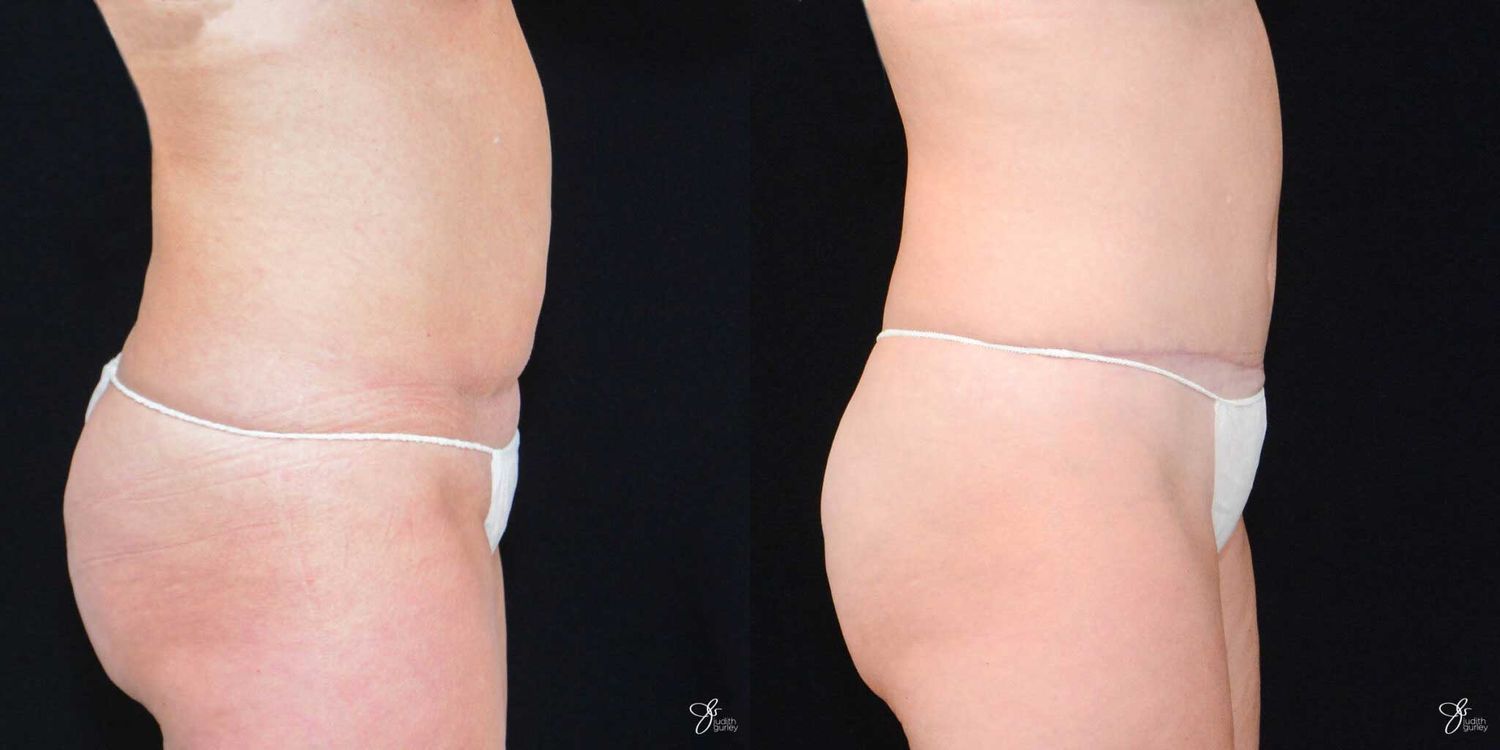 Tummy Tuck Before & After