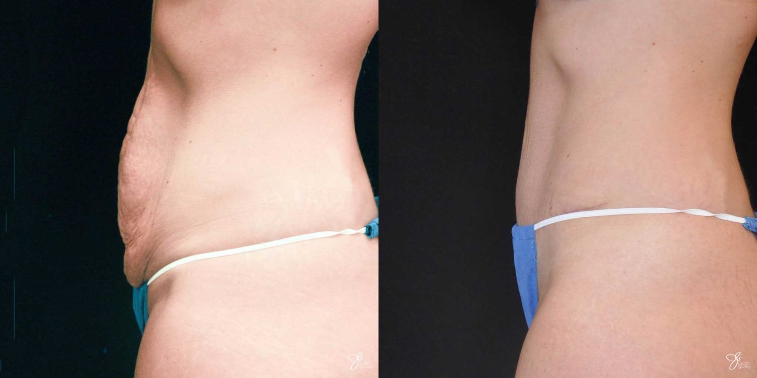 Tummy Tuck Before & After