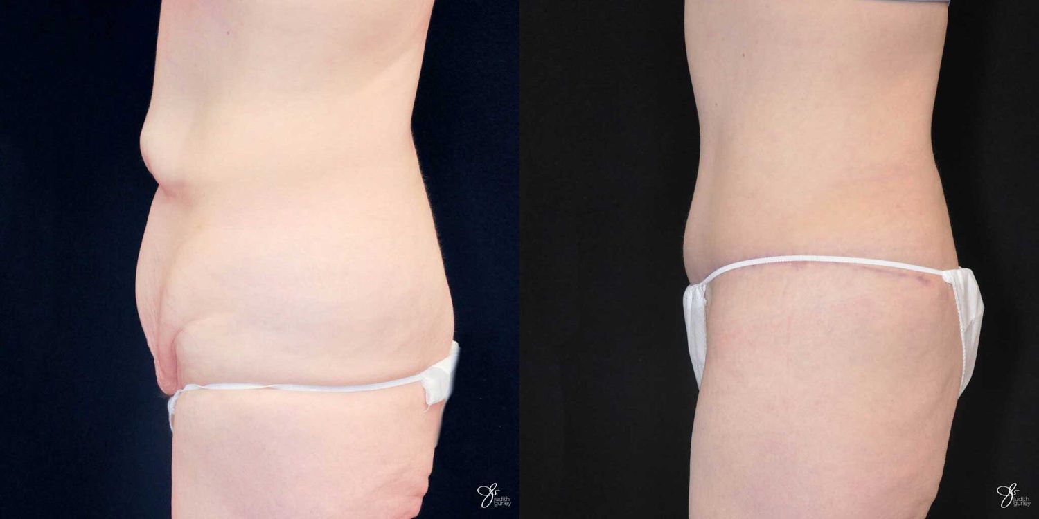 Tummy Tuck Before & After