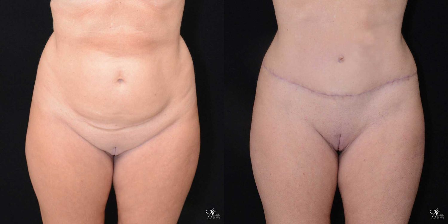 Tummy Tuck Before & After