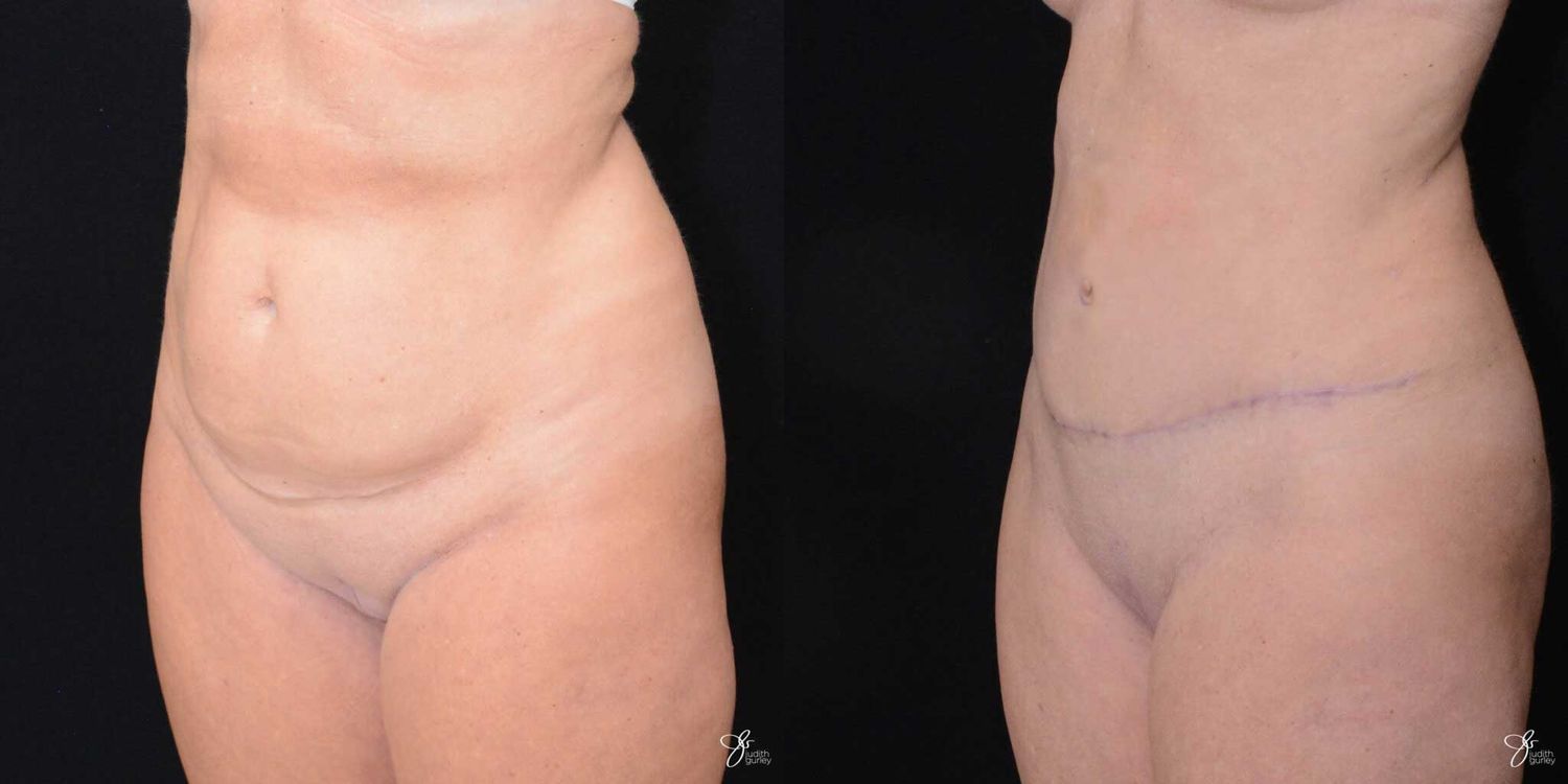 Tummy Tuck Before & After