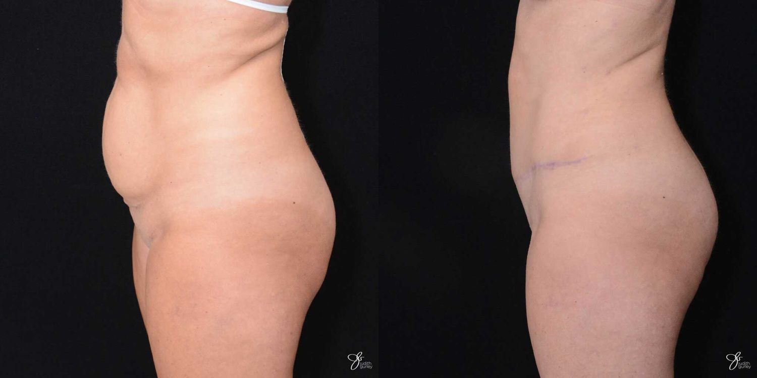 Tummy Tuck Before & After