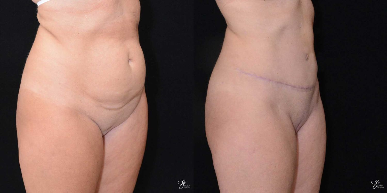 Tummy Tuck Before & After