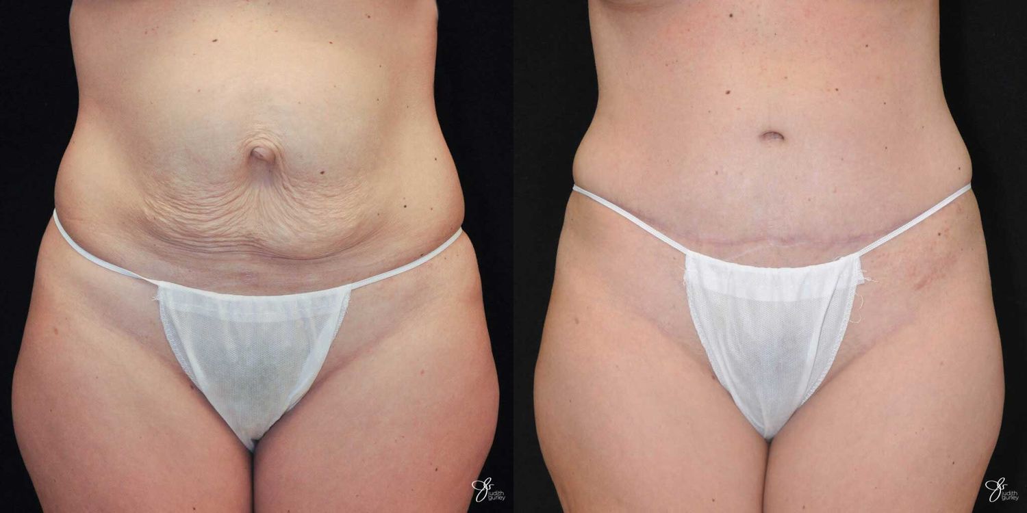 Tummy Tuck Before & After
