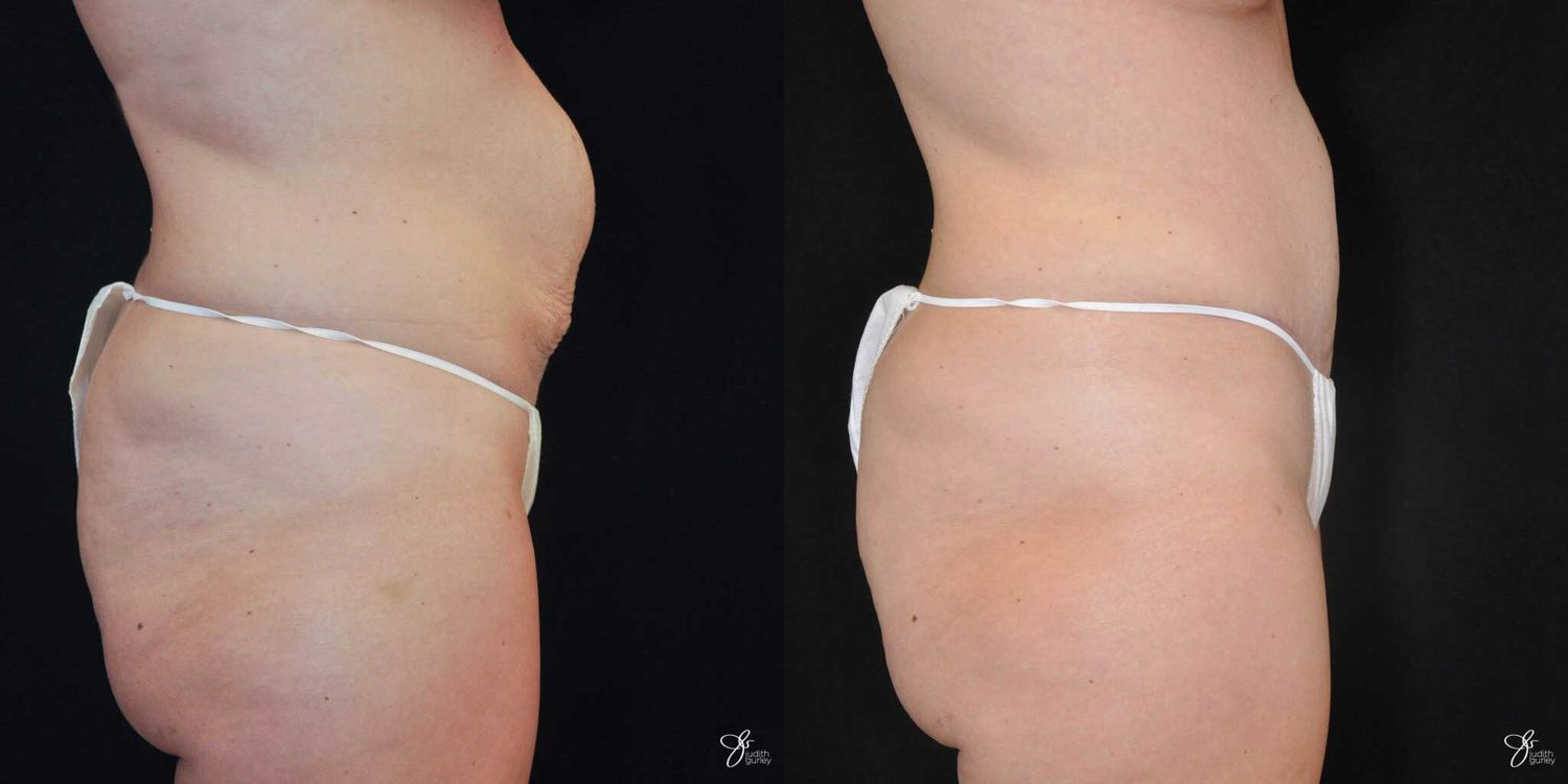 Tummy Tuck Before & After