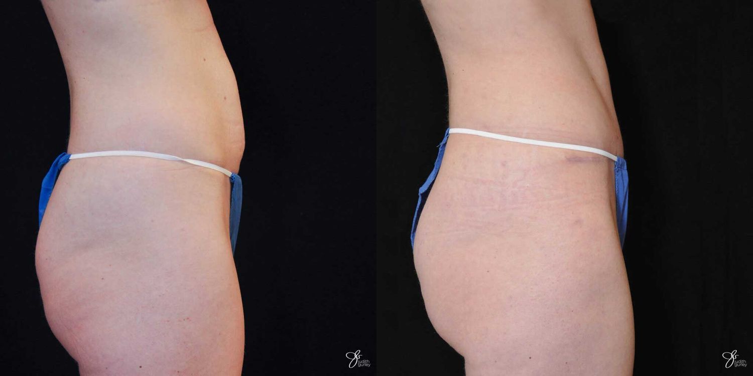 Tummy Tuck Before & After